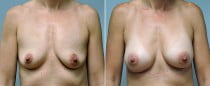 Dr. Conway Breast Augmentation