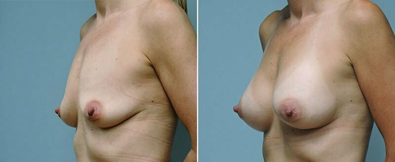 breast-augmentation-6602b-conway
