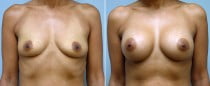 Dr. Conway Breast Augmentation