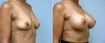 breast-augmentation-6607b-conway