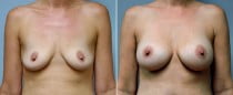 Dr. Conway Breast Augmentation