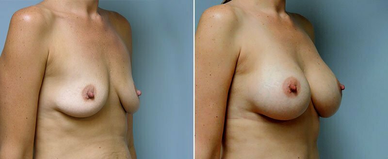 breast-augmentation-6617b-conway