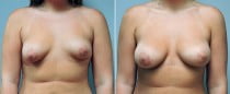 Dr. Conway Breast Augmentation