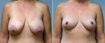 Dr. Conway Breast Lift