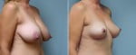breast-lift-6448b-conway