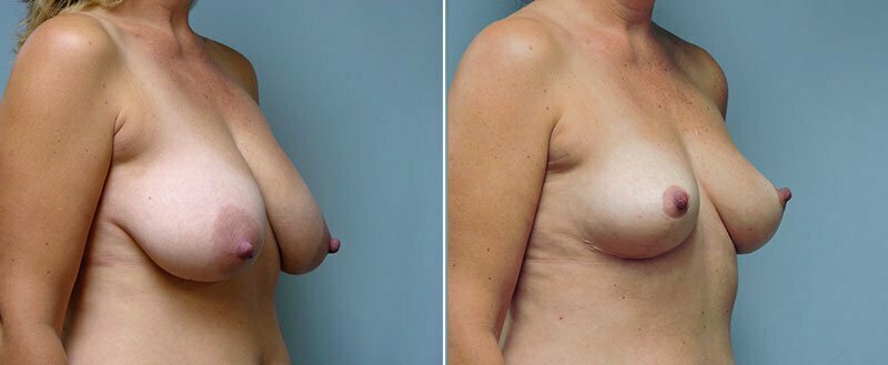 breast-lift-6448b-conway