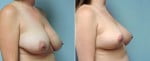 breast-lift-6453b-left-conway