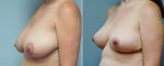 breast-lift-6453b-right-conway