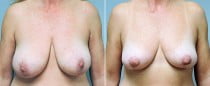 Dr. Conway Breast Lift