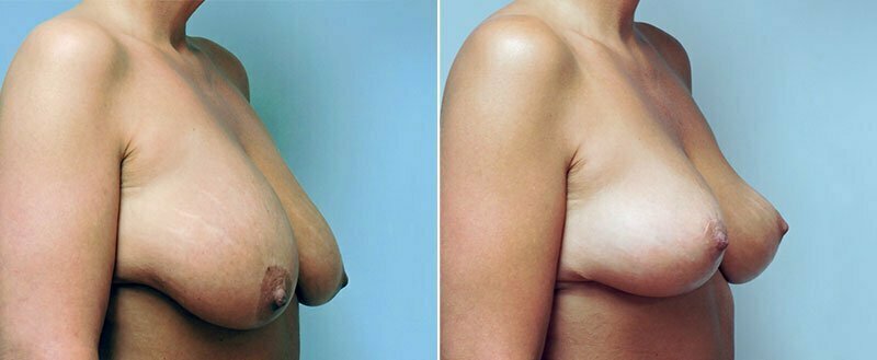 breast-lift-6467b-conway