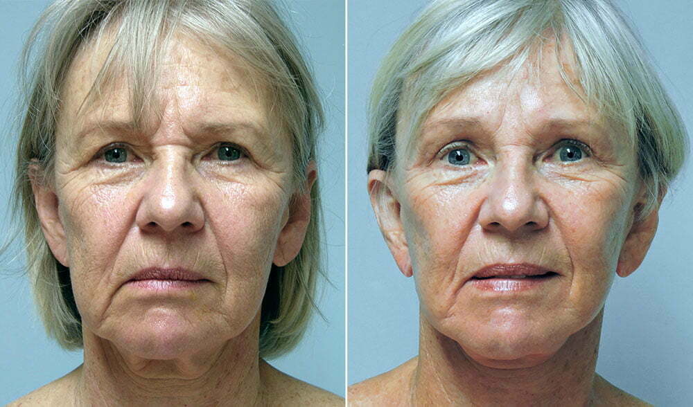 Female eyelid lift patient of Dr. Conway shown before and after blepharoplasty surgery with Dr. Donald Conway