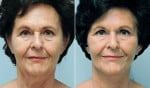 facelift-neck-lift-6238a-conway