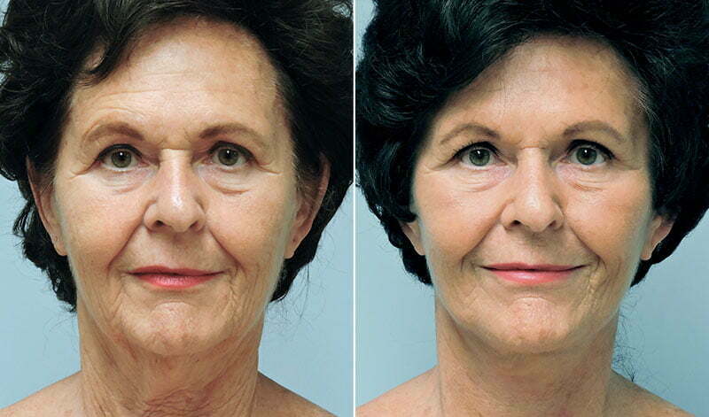Before and after face and necklift with Asheville plastic surgeon Dr. Donald Conway