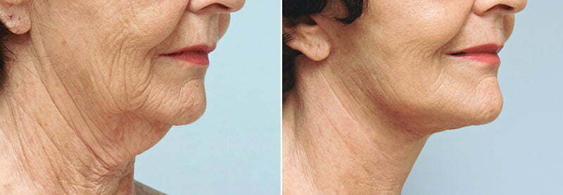 facelift-neck-lift-6238b-conway