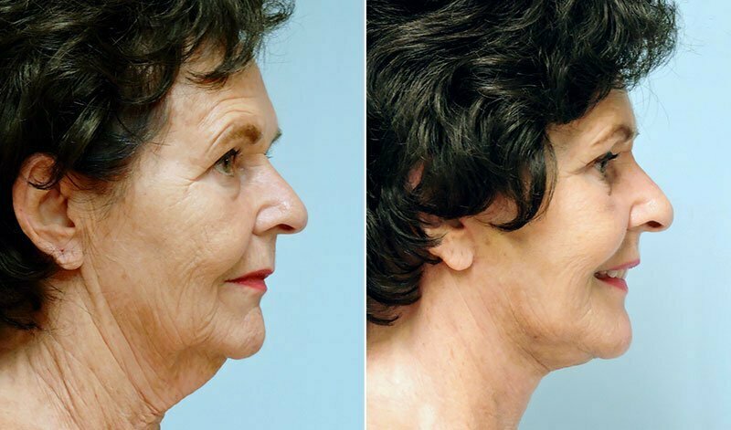 Before and after neck lift surgery