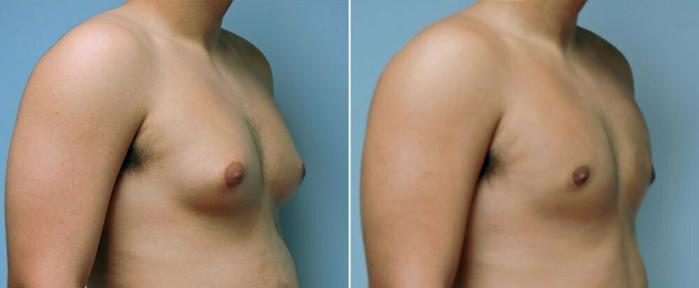 Man before and after treatment for gynecomastia with plastic surgeon Dr. Donald Conway