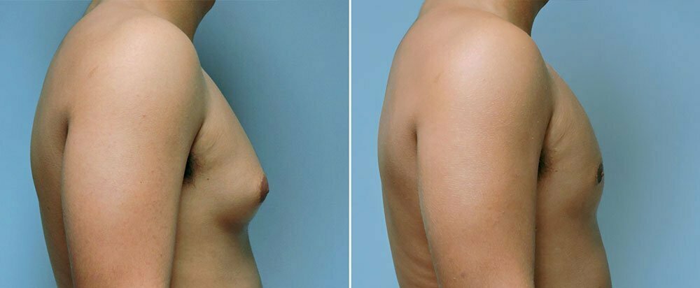 Male patient before and after gynecomastia procedure to remove excess breast tissue