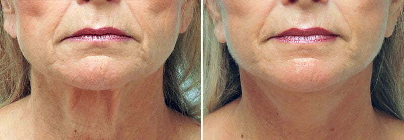 Lower face and neck lift with Asheville plastic surgeon Dr. Donald Conway