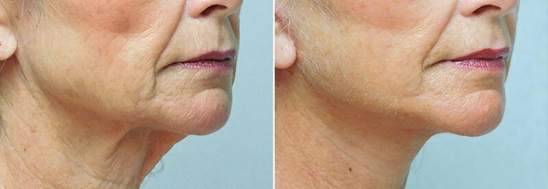 Before and after a lower facelift and neck life with Asheville plastic surgeon Dr. Donald Conway