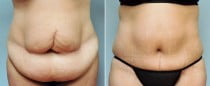 Dr. Conway Tummy Tuck