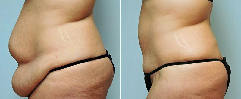 Tummy tuck shown from the side