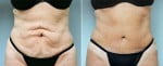 tummy-tuck-6359a-conway