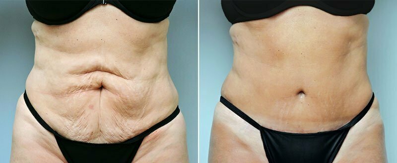 Before and after tummy tuck by Asheville plastic surgeon Dr. Donald Conway