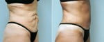 tummy-tuck-6359b-conway