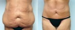 tummy-tuck-6364a-conway