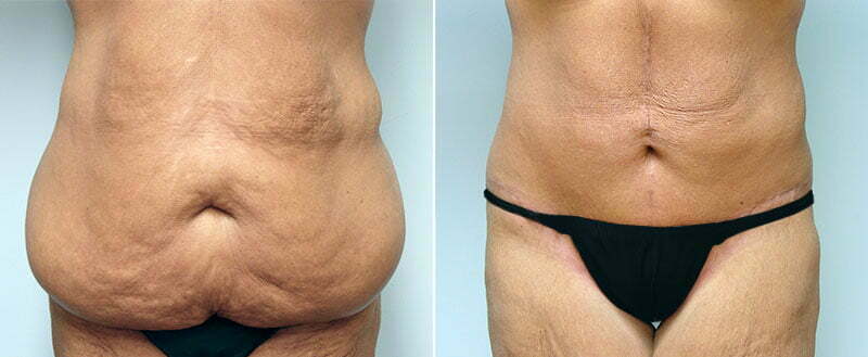 Excess skin removal from abdomen