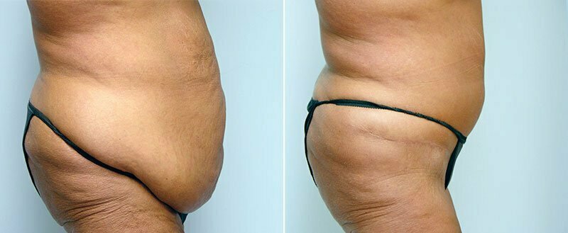 Before and after tummy tuck