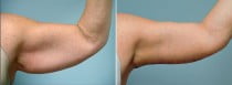 Dr. Conway Upper Arm Lift