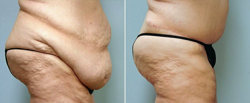 Side view of before and results after body lift surgery