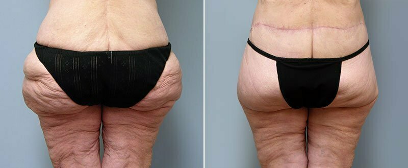 Before and after thigh and buttock body lift with Dr. Donald Conway