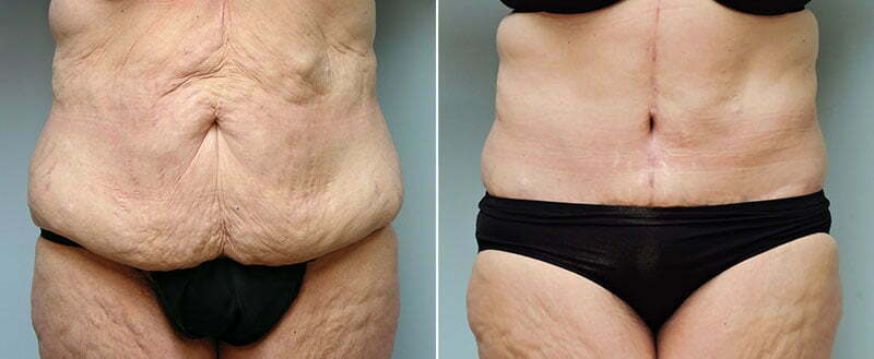 Before and after body lift Dr. Donald Conway