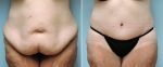 tummy-tuck-8286a-conway