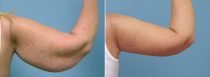 Dr. Conway Upper Arm Lift