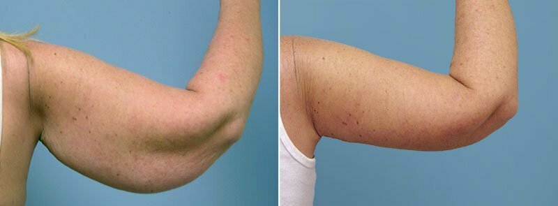 Before and after upper arm lift with Dr. Conway in Asheville