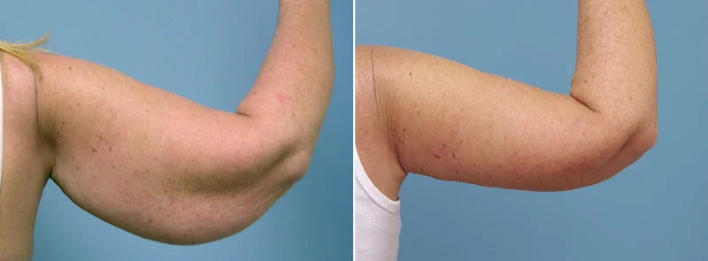 Before and after upper arm lift with Dr. Conway in Asheville
