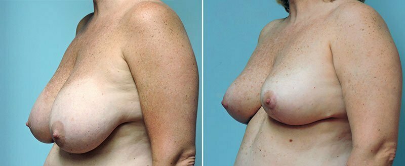 breast-reduction-8738b-conway