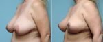 breast-reduction-8744b-conway