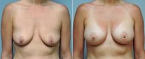 Dr. Conway Breast Augmentation