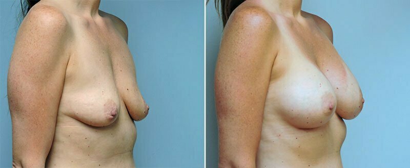 breast-augmentation-10977-07b-conway