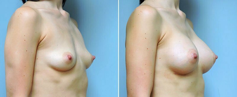 breast-augmentation-10977-11b-conway