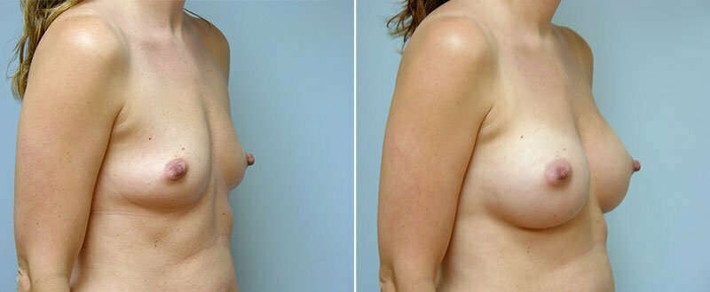 breast-augmentation-10977-15b-conway