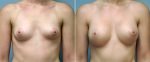 breast-augmentation-10977-19a-conway