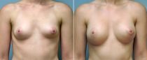 Dr. Conway Breast Augmentation