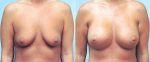 breast-augmentation-10977-23a-conway