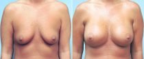 Dr. Conway Breast Augmentation