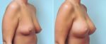 breast-augmentation-10977-23b-conway